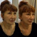 Процедура подтяжки лица нитями молдинг. Использовали 12 нитей.  Фото до и сразу после процедуры. Использую технику с минимальной реабилитацией  отсутствием синяков и проколов. 
