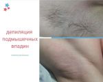 Восковая депиляция 
