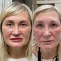 Были выполнены две процедуры - напыление губ в технике