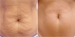 Шлифовка живота, произведено 8 процедур, интервал месяц