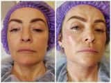 Полимолочная кислота AestheFill.
35000 руб. 