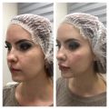 Контурная пластика губ и скул, плюс векторный лифтинг.