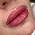 Свежие губы сразу после процедуры 