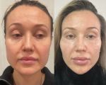 Сделана коррекция овала, поднятие и уплотнение щек, нитевой лифтинг, контурная пластика скул, подбородка, нижней челюсти 