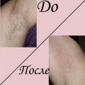 Мужские подмышки. Удаление первый раз.