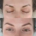 Зажившие брови перед коррекцией, перекрытие после частичного удаления лазером 