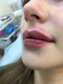 Аугментация губ препаратом Платинум 1,1 мл