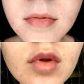 Коррекция формы губ.