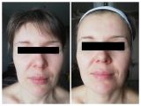 до и после УЗ чистки лица