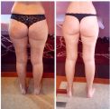 Антицеллюлитный массаж ,до/после