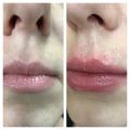 Коррекция губ филером Revanesse