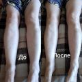 Лимфодренажный массаж нижних конечностей