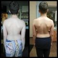 Мальчик 11-ти лет. Видна ассиметрия со стороны спины. Нарушение осанки. Слева фото до начала курса и ЛФК. Справа фото после 10-ти дневного курса. Рузультат очевиден