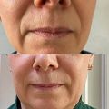 Коррекция носогубной складки 