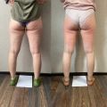 Фото до и после - 7 сеансов 