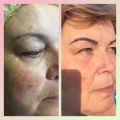 Уже зажившие бровки. Обошлись без коррекции.