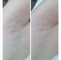Депиляция подмышечной зоны 