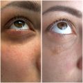 Устранение темных кругов под глазами, результат на фото после 1ой процедуры 