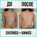 Исправили искривление позвоночника с 3-4 степени на 1-2 степень, осанка выпрямилась, назначено было 10 процедур + лфк ШРОТ