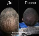 Трихопигментация залысин, метод нанесения пигмента микро точками.
Загущение волос