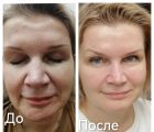Коррекция неровностей на лбу и подбородочной области без инъекций