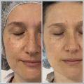 Фотоомоложение(IPL)-4 процедуры.