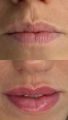 Губы до перманента и уже зажившие спустя 2 процедуры. 
Так же была выполнена процедура коррекции губ филлером у косметолога. 