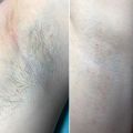 Шугаринг подмышечной впадины