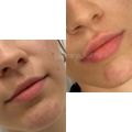 Коррекция ассиметрии, формы и объёма губ. 
