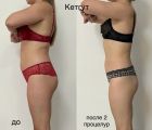 Кетгут-терапия - это одновременно процесс лечения и похудения, так как работа всех жизненно важных органов нормализуется. 
Заключающийся не только в подтяжке кожи, избавлении от лишнего веса, но и настройки правильной работы внутренних органов. 

Эффект от процедуры.
В зависимости от индивидуальных особенность организма пациента, после кетгут-терапии, объемы могут уменьшаться до 6 сантиметров в талии, а у некоторых вплоть до 20.