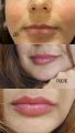 Увеличение губ  препаратом стилаж м 