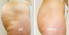 Снижение жировых отложений и целлюлита.
        