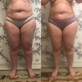 Уменьшили целлюлит и ушки, кожа подтянулась, ушли объёмы. 5 сеансов