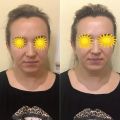 Миофасциальный ( изменился овал Лица, за счёт снятия Отёка)