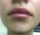 Коррекция губ, фото сразу после процедуры