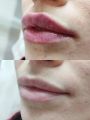 Филлеры-увеличение губ