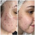 💫Результат за 2 процедуры «Анти Акне»💫