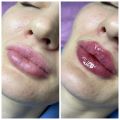 Увеличение губ по технике Гаруновой «плоский бант»