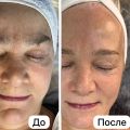 Процедура подходит пациентам с первыми признаками старения, эффективно разглаживает морщинки за счет стимуляции коллагена и эластина. Придает лицу гладкость, сужает поры, оздоравливает цвет лица ?