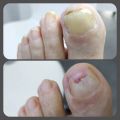 Обработка утолщенных ногтей. От 1000р. Работаем на проф. оборудовании Suda с применением косметики этой же фирмы ( Германия) 