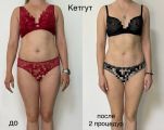 Кетгут-терапия - это одновременно процесс лечения и похудения, так как работа всех жизненно важных органов нормализуется. 
Заключающийся не только в подтяжке кожи, избавлении от лишнего веса, но и настройки правильной работы внутренних органов. 

Эффект от процедуры.
В зависимости от индивидуальных особенность организма пациента, после кетгут-терапии, объемы могут уменьшаться до 6 сантиметров в талии, а у некоторых вплоть до 20.