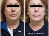 Улучшение цвета и текстуры кожи.
Подтяжка овала лица.
Устранение отеков и улучшение лимфодренажа.