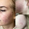 Лечение акне/постакне (промежуточный результат)