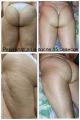 Результат антицеллюлитного массажа. 